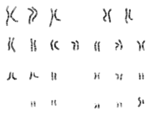 prenatal genetic testing image of a karyotype
